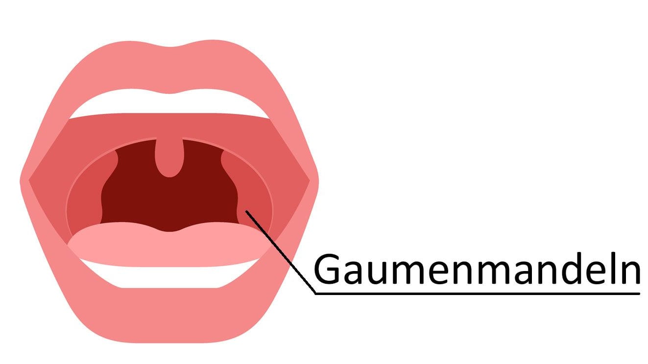 Gaumenmandeln