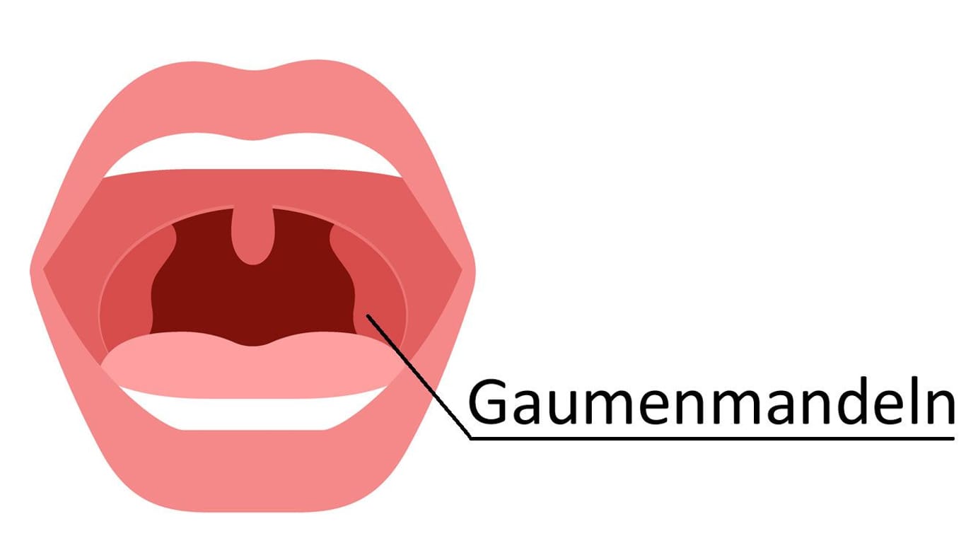 Gaumenmandeln