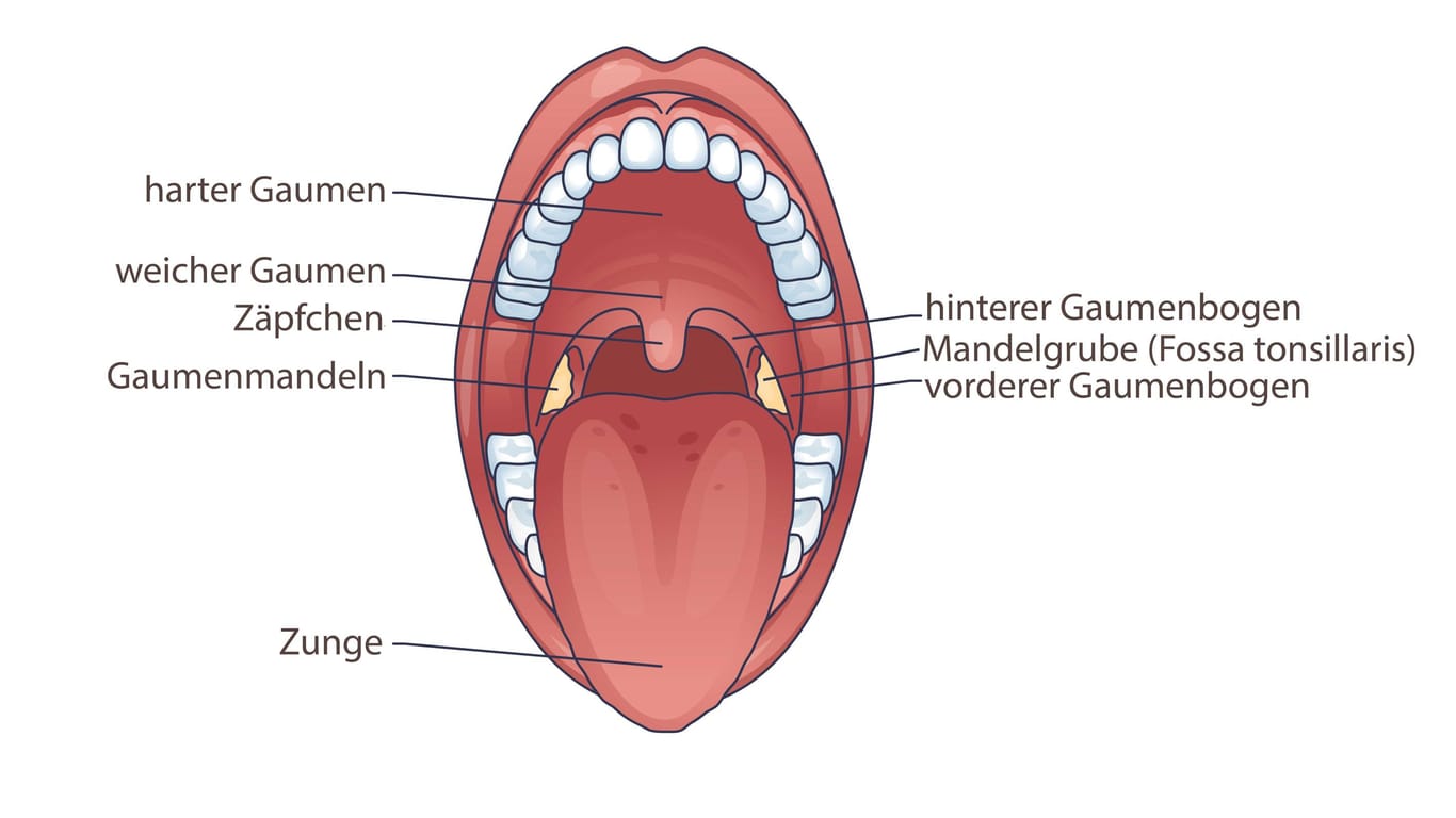 Anatomie Gaumenmandeln: Löst leichter Druck auf die Mandelgrube (Fossa tonsillaris) Schmerzen in Gesicht, Ohr oder Kopf aus, kann das auf das Eagle-Syndrom hinweisen.