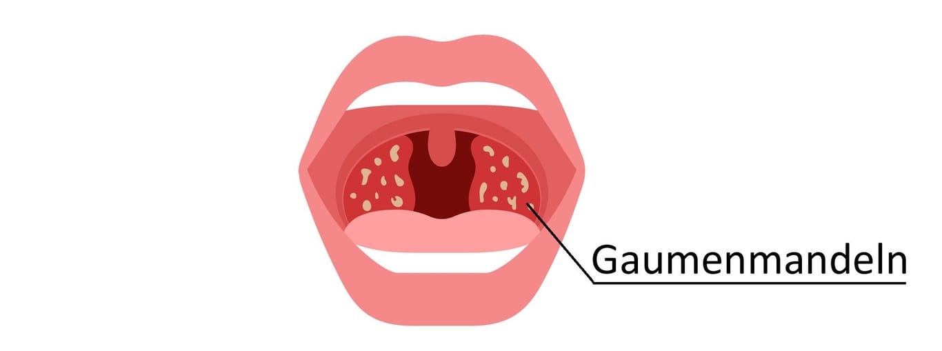 Bilder von Mandelentzündung So sieht eine Tonsillitis aus