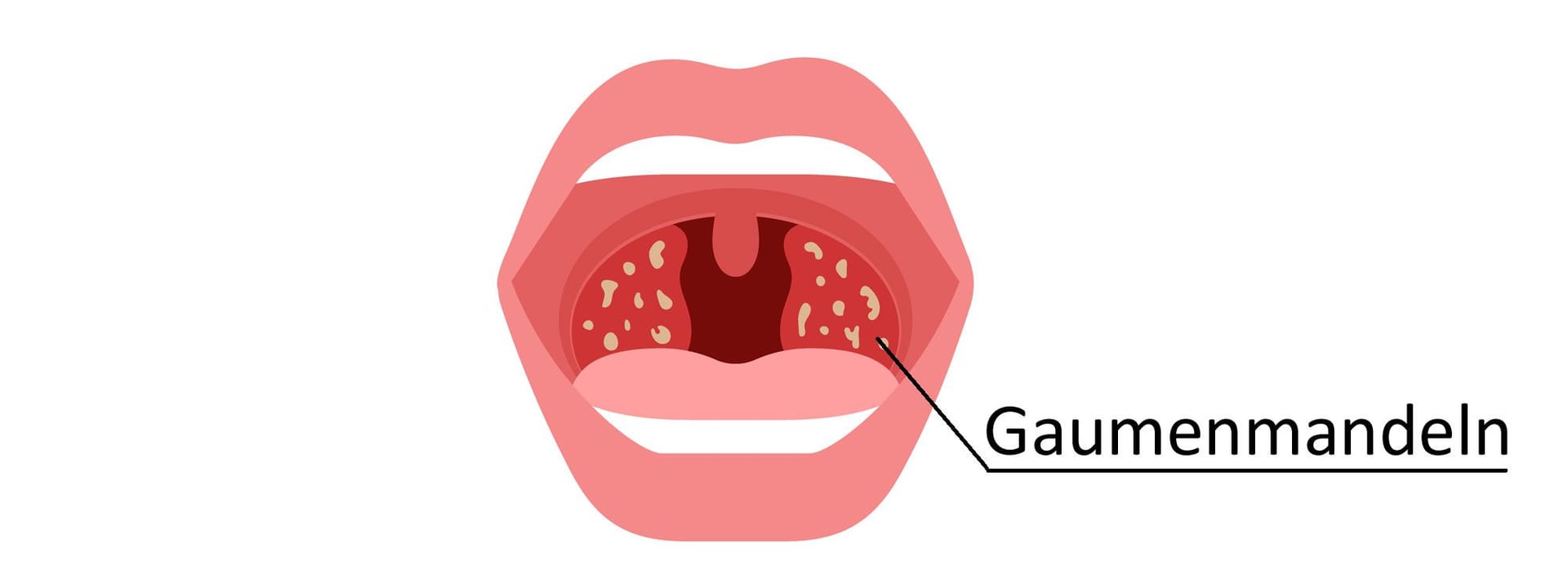 Illustration einer Mandelentzündung