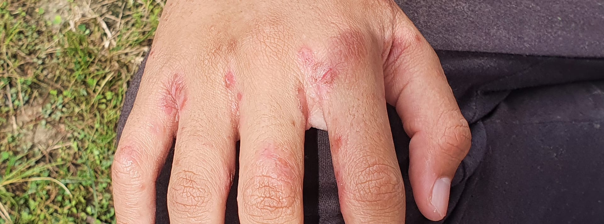 Sichtbare Krätze-Symptome auf einer Hand