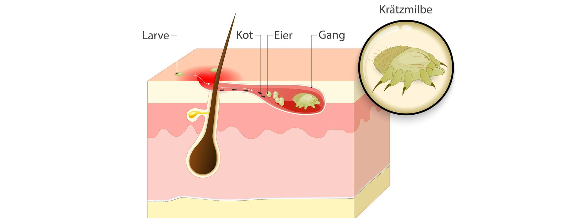 Illustration eines Krätzebefalls der Haut