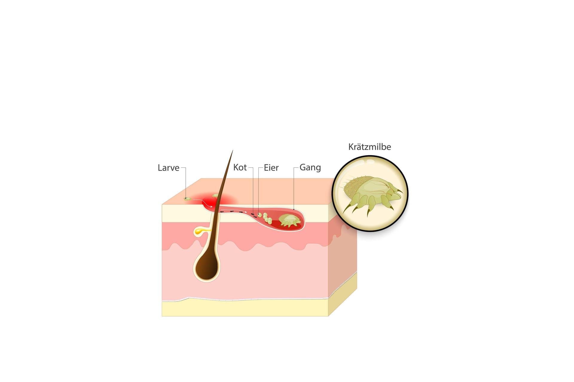 Illustration eines Krätzebefalls der Haut