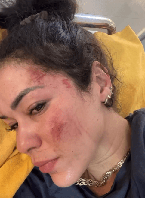 Fernanda zeigt sich mit den Wunden auf Instagram: Die 28-Jährige reist mit ihrem Partner durch die Welt, nun wurden sie Opfer eines Angriffs.