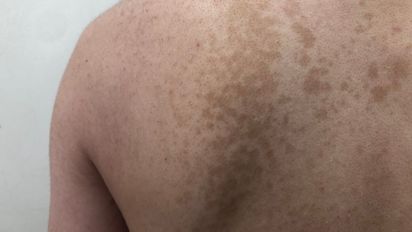 Rücken einer Person mit braunen Flecken auf der Haut