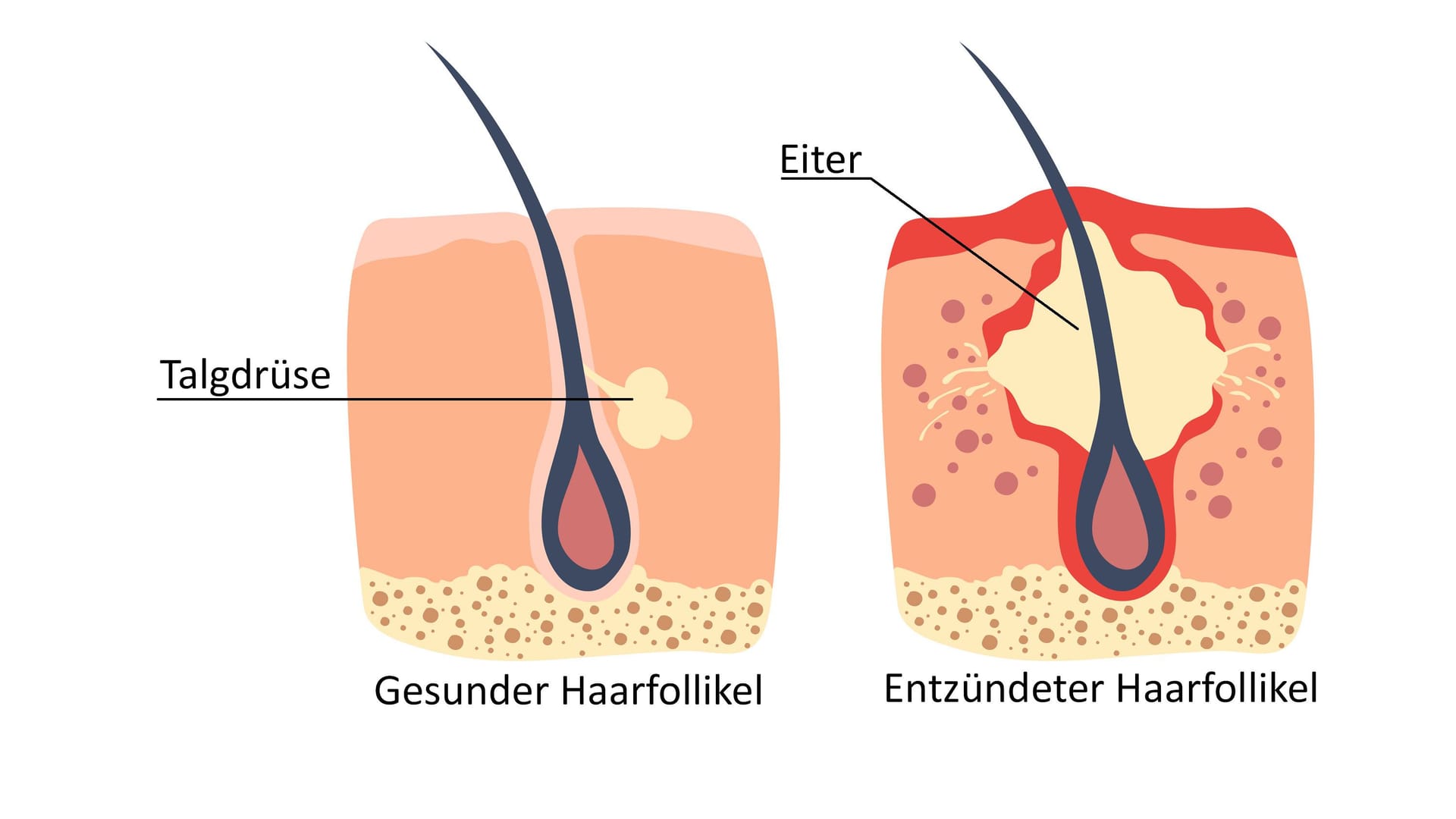 Illustration: Gesunder und entzündeter Haarfollikel