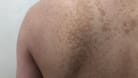 Rücken einer Person mit braunen Flecken auf der Haut