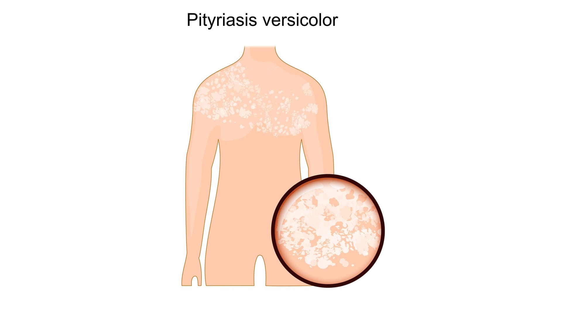 Illustration: Kleienpilzflechte (Pityriasis versicolor)