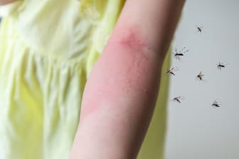 Juckreiz und starke Schwellung: Manche Menschen reagieren stärker auf Mückenstiche als andere.