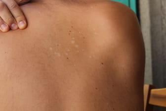 Rücken einer Person mit weißen Flecken auf der Haut