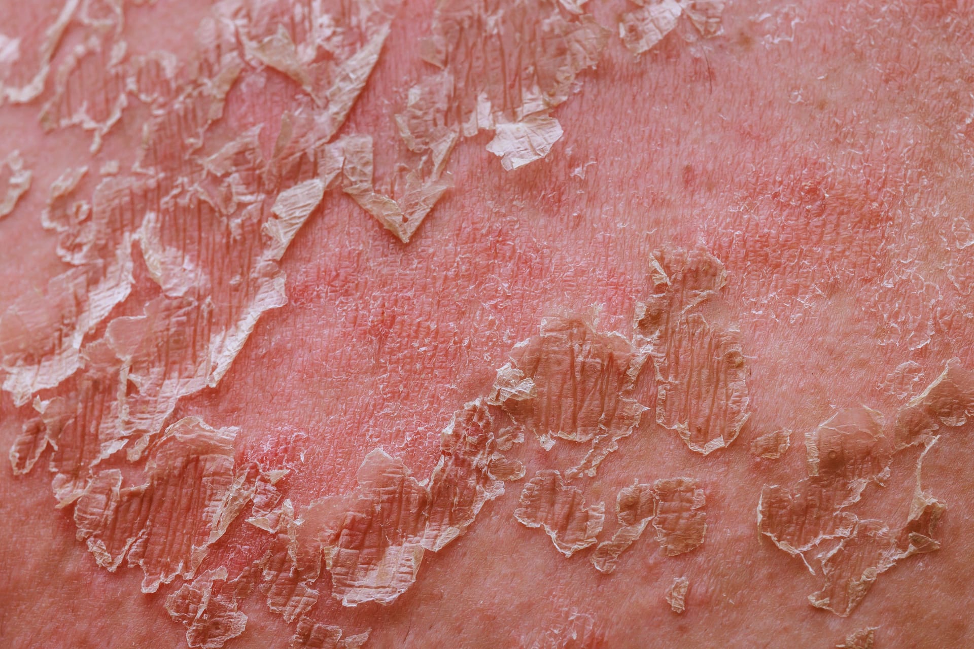 Human body develops irritated reddened skin with flaking cell scales after a sunburn.