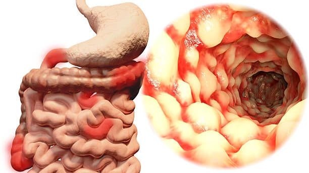 Morbus Crohn: Bei der entzündlichen Darmerkrankung kann jeder Teil des Verdauungstrakts infiziert sein.