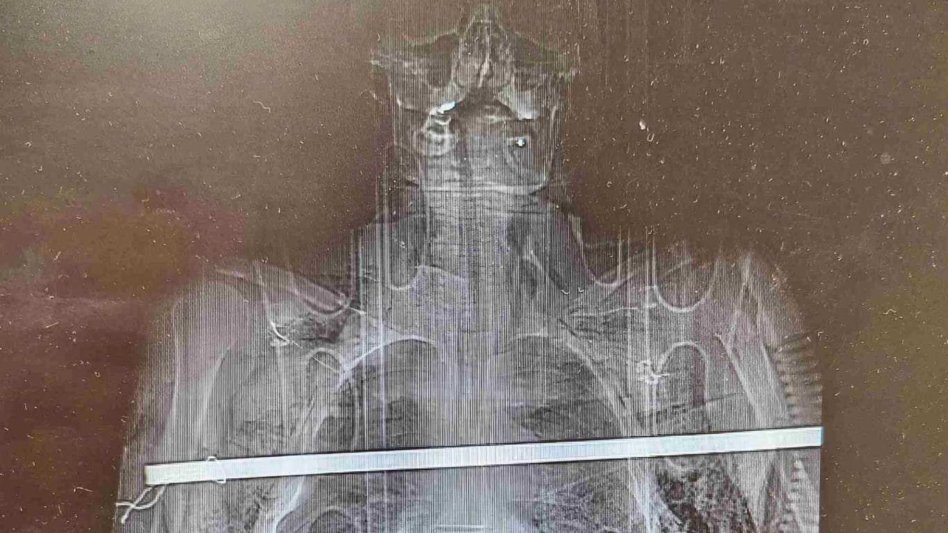 Röntgenbild des Verletzten: Die Stange ging einmal durch seinen Körper.