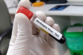 Test auf Mpox: Das Virus kann im Blut nachgewiesen werden.