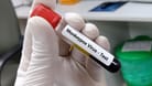 Test auf Mpox: Das Virus kann im Blut nachgewiesen werden.