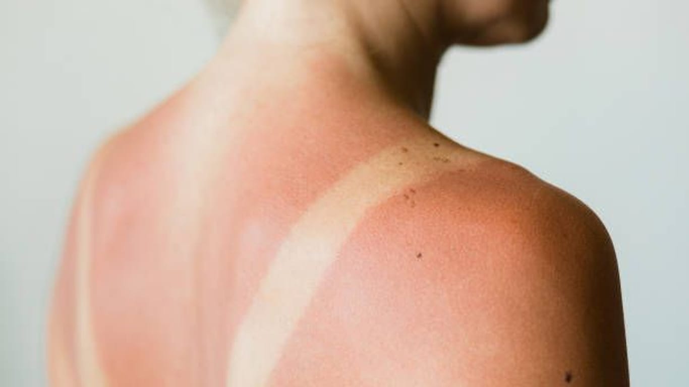 Gesundheitsrisiko: Sonnenbrand beschleunigt die Hautalterung und ist in den meisten Fällen eine Hauptursache für Hautkrebs.