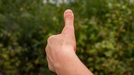 Brachydaktylie Typ D: Betroffene haben einen sichtbar verkürzten, verdickten Daumen.