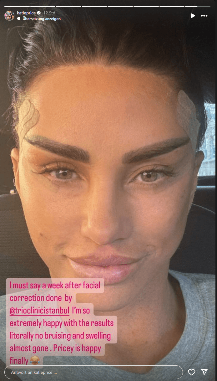 Katie Price zeigt sich nach ihrem Facelifting.