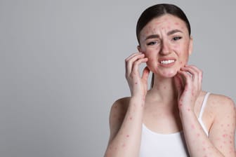 Woman with rash suffering from monkeypox virus on light grey background. Space for text