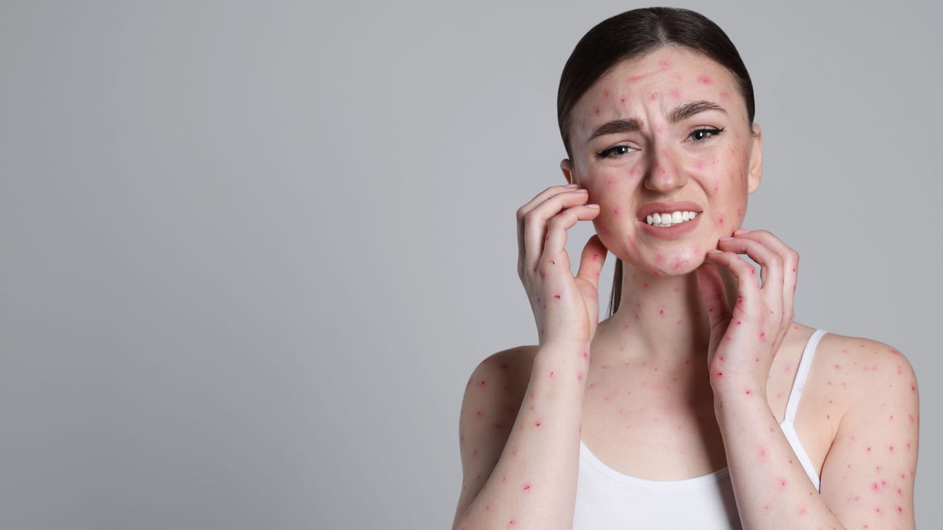 Woman with rash suffering from monkeypox virus on light grey background. Space for text