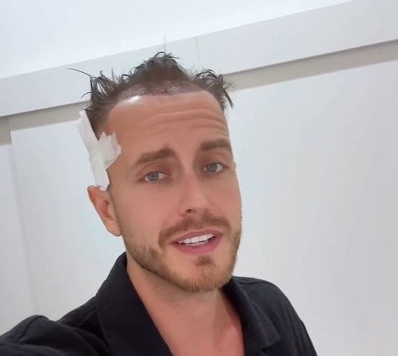 Julian Claßen nach einer Haartransplantation in Österreich.