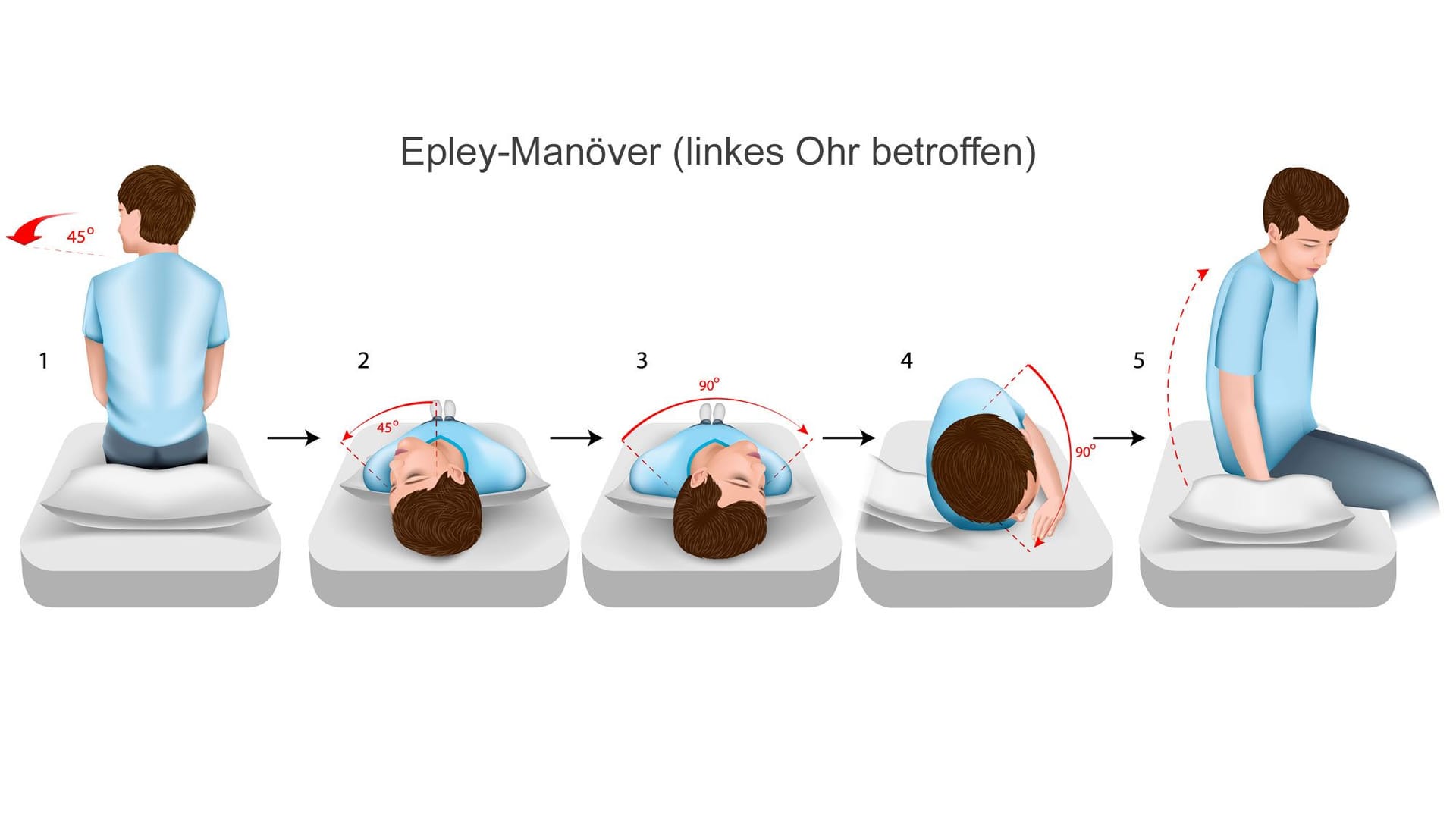 Epley-Manöver