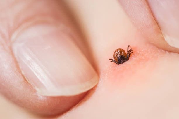 Zeckenstich: Er äußert sich meist durch eine gerötete, kreisförmige Stelle auf der Haut.