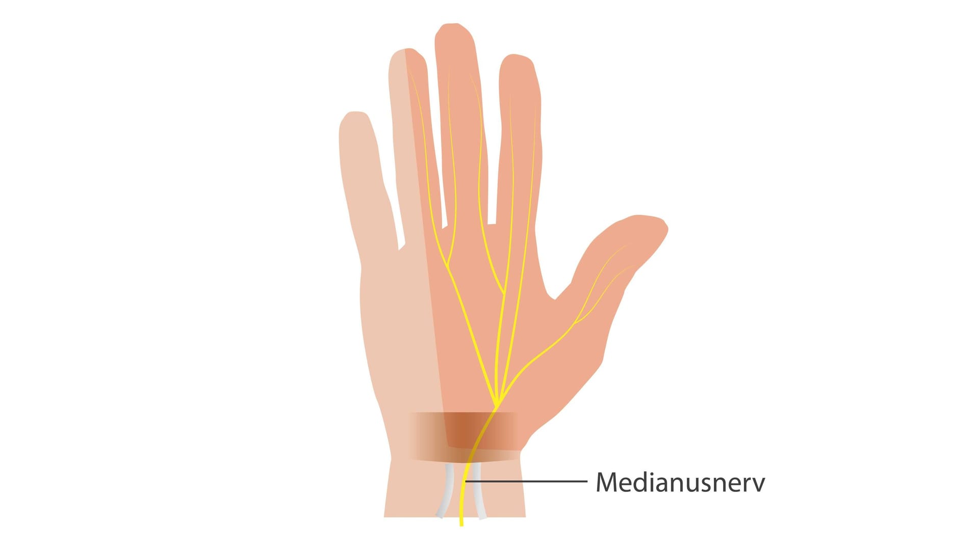 Mittig im Handgelenk verläuft der Medianusnerv im sogenannten Karpaltunnel.