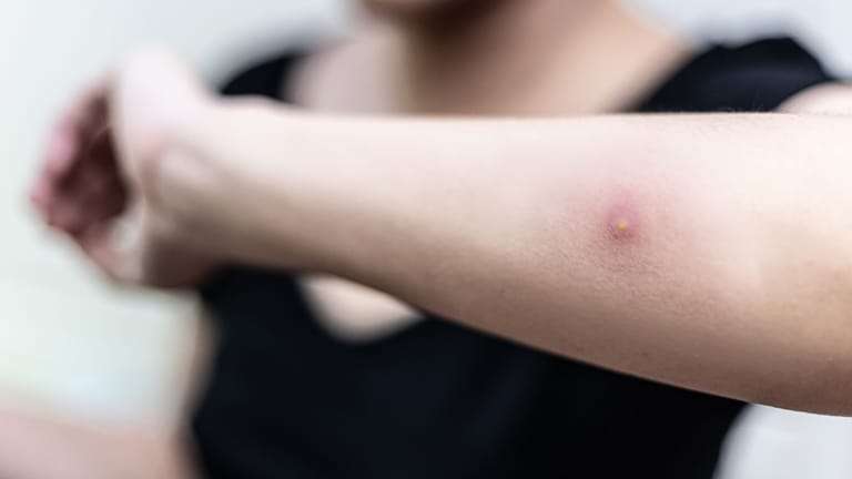 Verkapselter Fremdkörper Unter Der Haut www.t-online.de