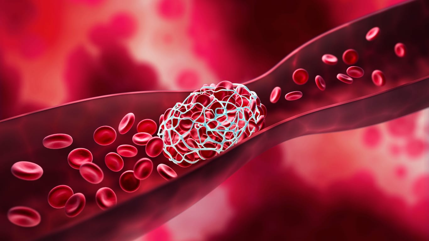 Thrombose: Blutgerinnsel können die Gefäße verstopfen und die Blutzufuhr in wichtige Organe unterbrechen.