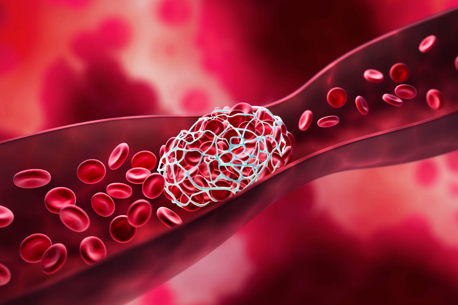 Thrombose: Blutgerinnsel können die Gefäße verstopfen und die Blutzufuhr in wichtige Organe unterbrechen.