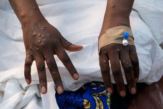 HEALTH-MPOX/ZAMBIA