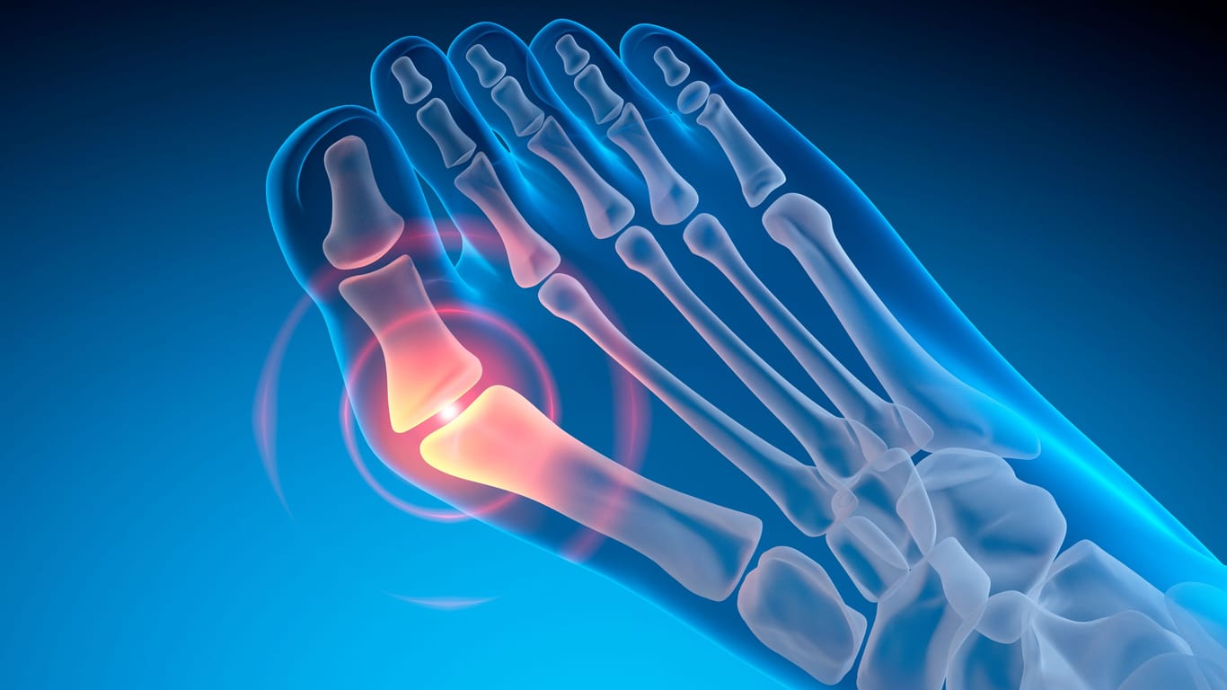 Grafische Darstellung eines Fußes mit Hallux valgus