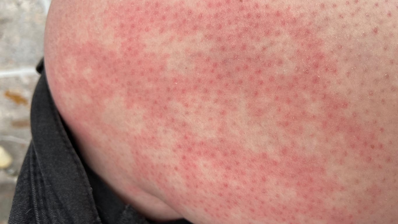 Erythema ab igne: Durch Wärme entsteht eine netzartige Rötung der Haut.