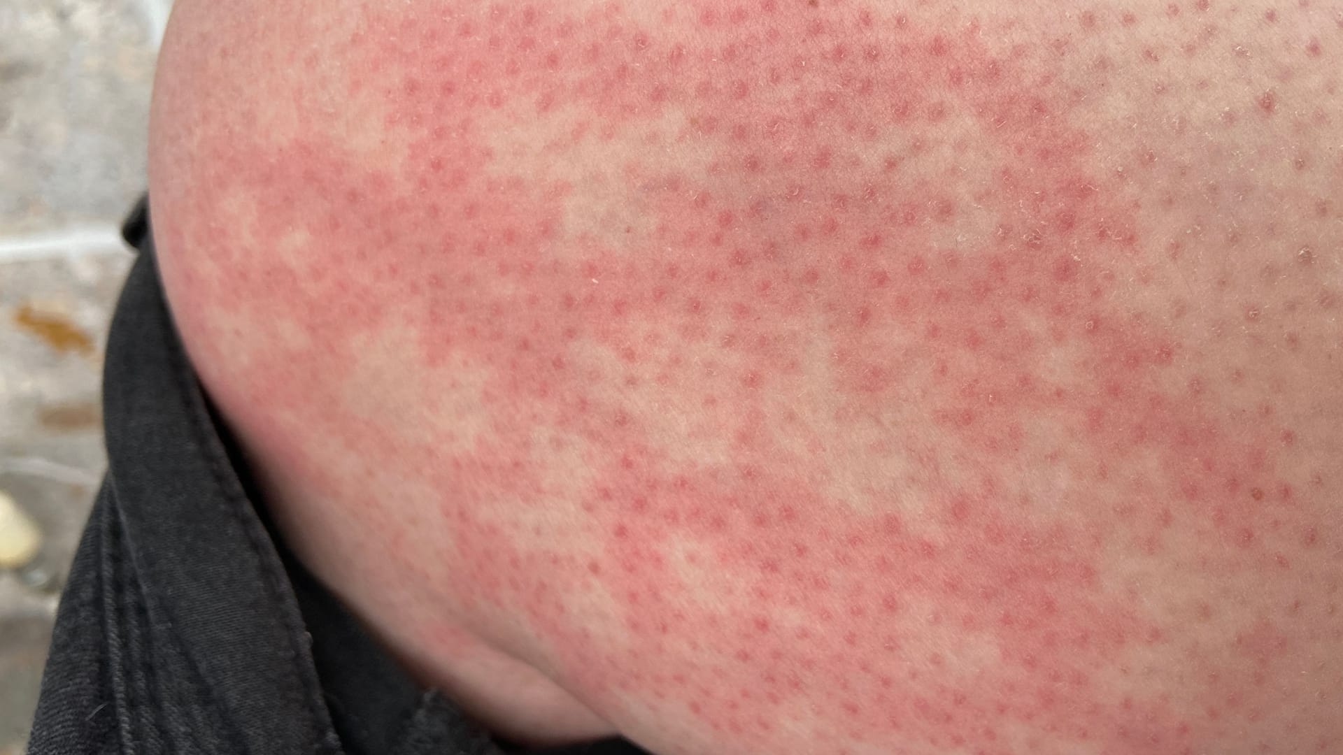 Erythema ab igne: Durch Wärme entsteht eine netzartige Rötung der Haut.