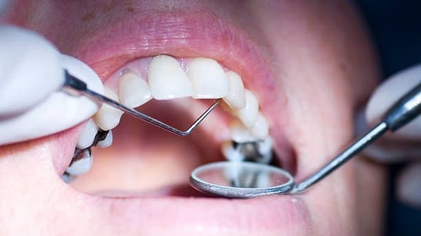 Karies im Backenzahn: Dentalamalgam wird schon seit weit über 100 Jahren für Zahnfüllungen verwendet.