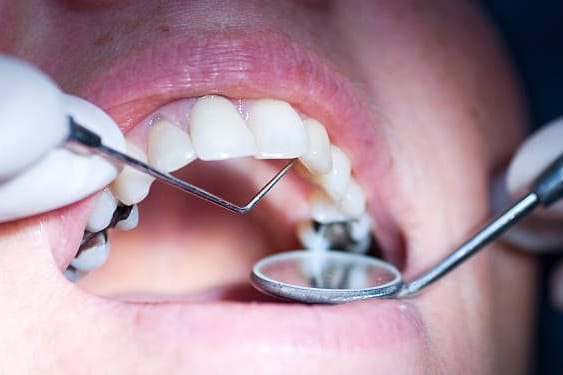 Karies im Backenzahn: Dentalamalgam wird schon seit weit über 100 Jahren für Zahnfüllungen verwendet.