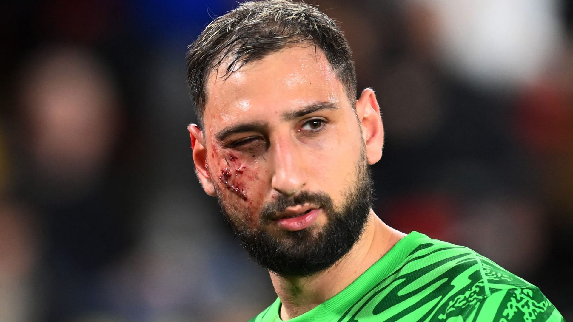 Gianluigi Donnarumma musste mit blutendem Gesicht den Platz verlassen.