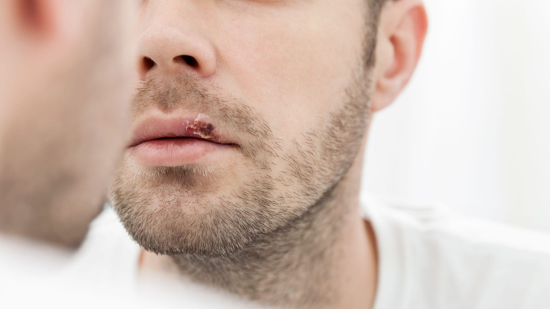 Mann mit abheilendem Lippenherpes