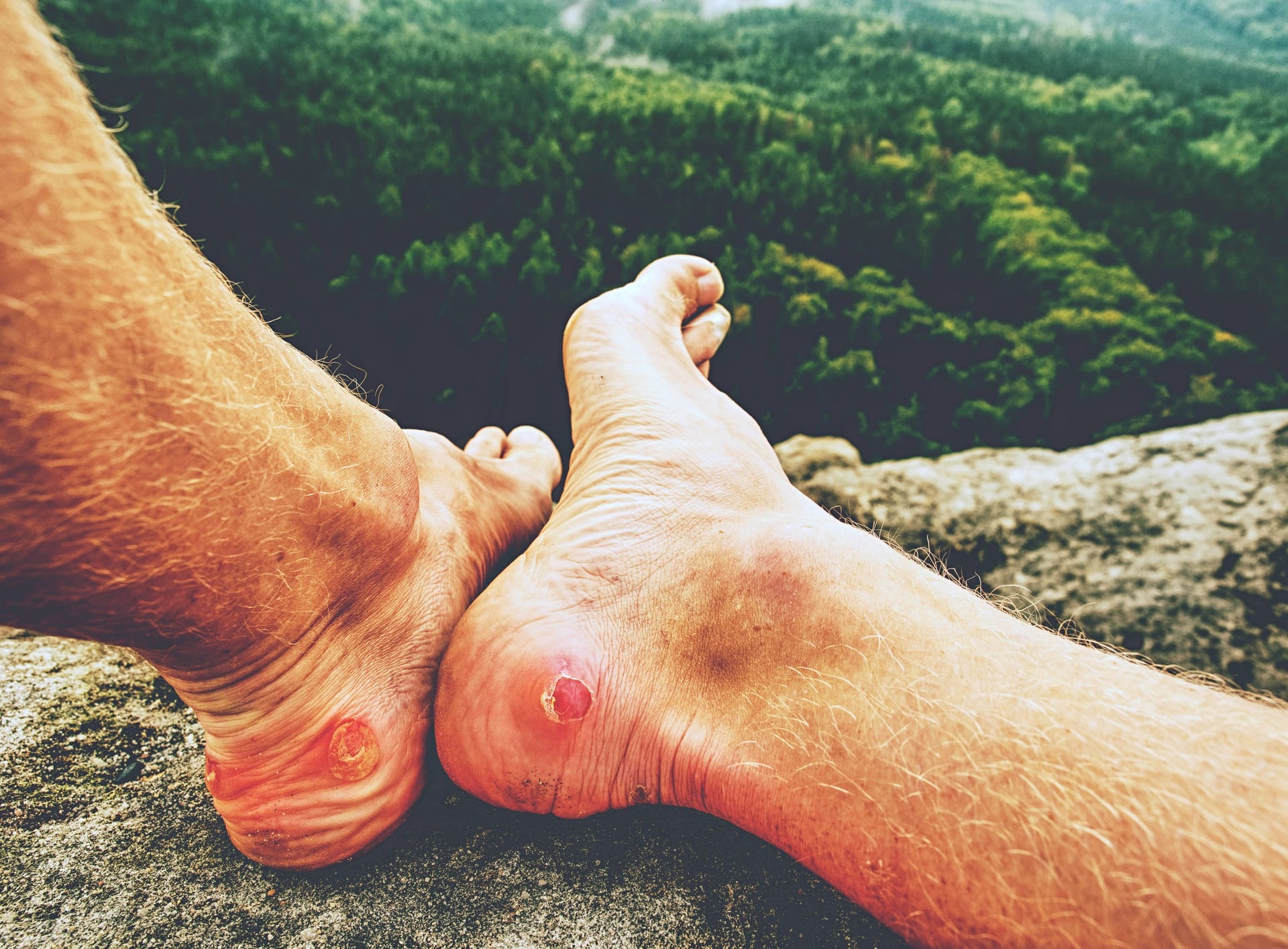 Blasen an den Hacken: Solche Wunden werden häufig durch das falsche Schuhwerk oder falsche Socken verursacht.