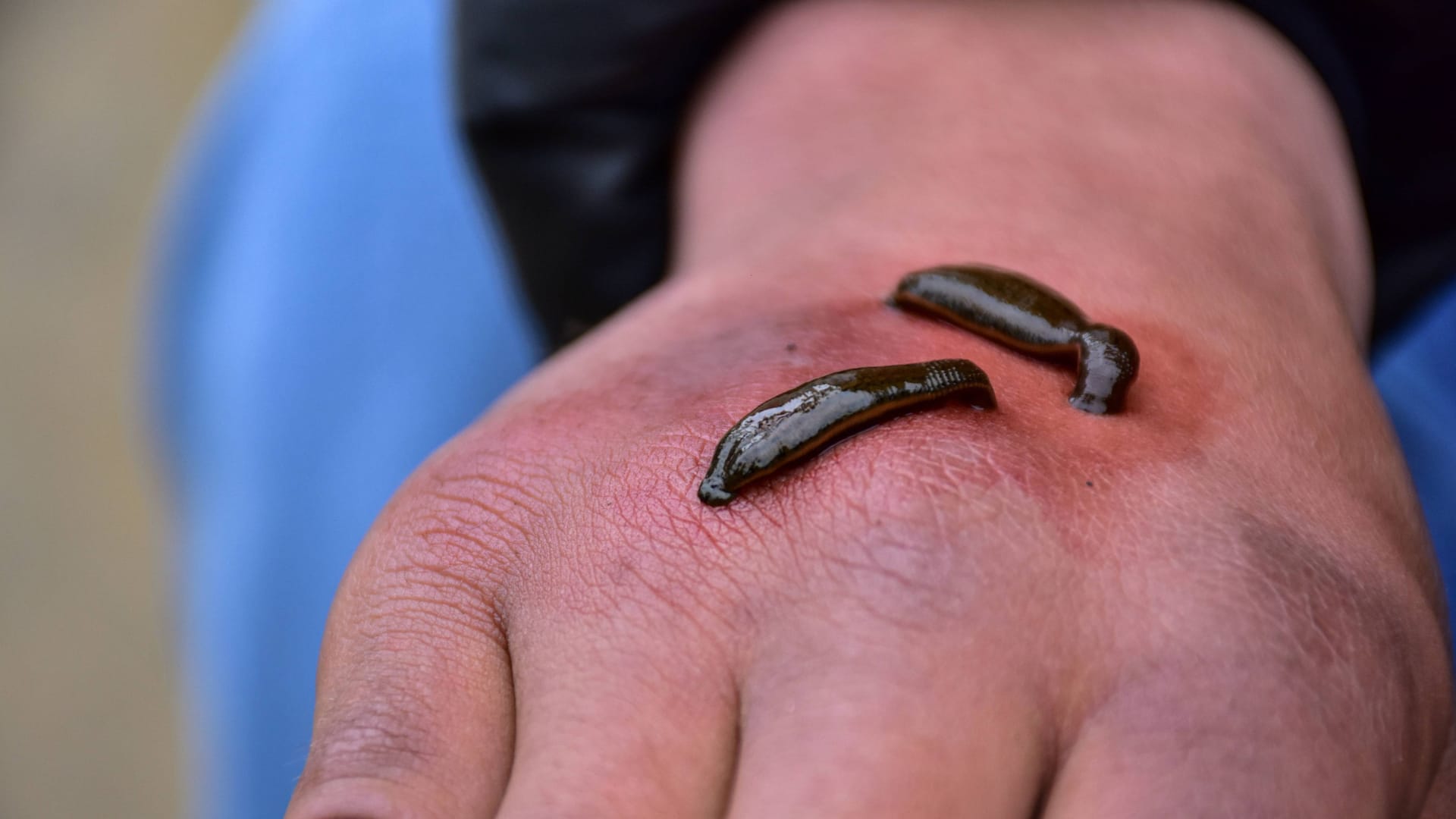 Blutegel auf einer Hand (Symbolbild): Die Wurmerkrankung betraf einen Bremer Patienten.