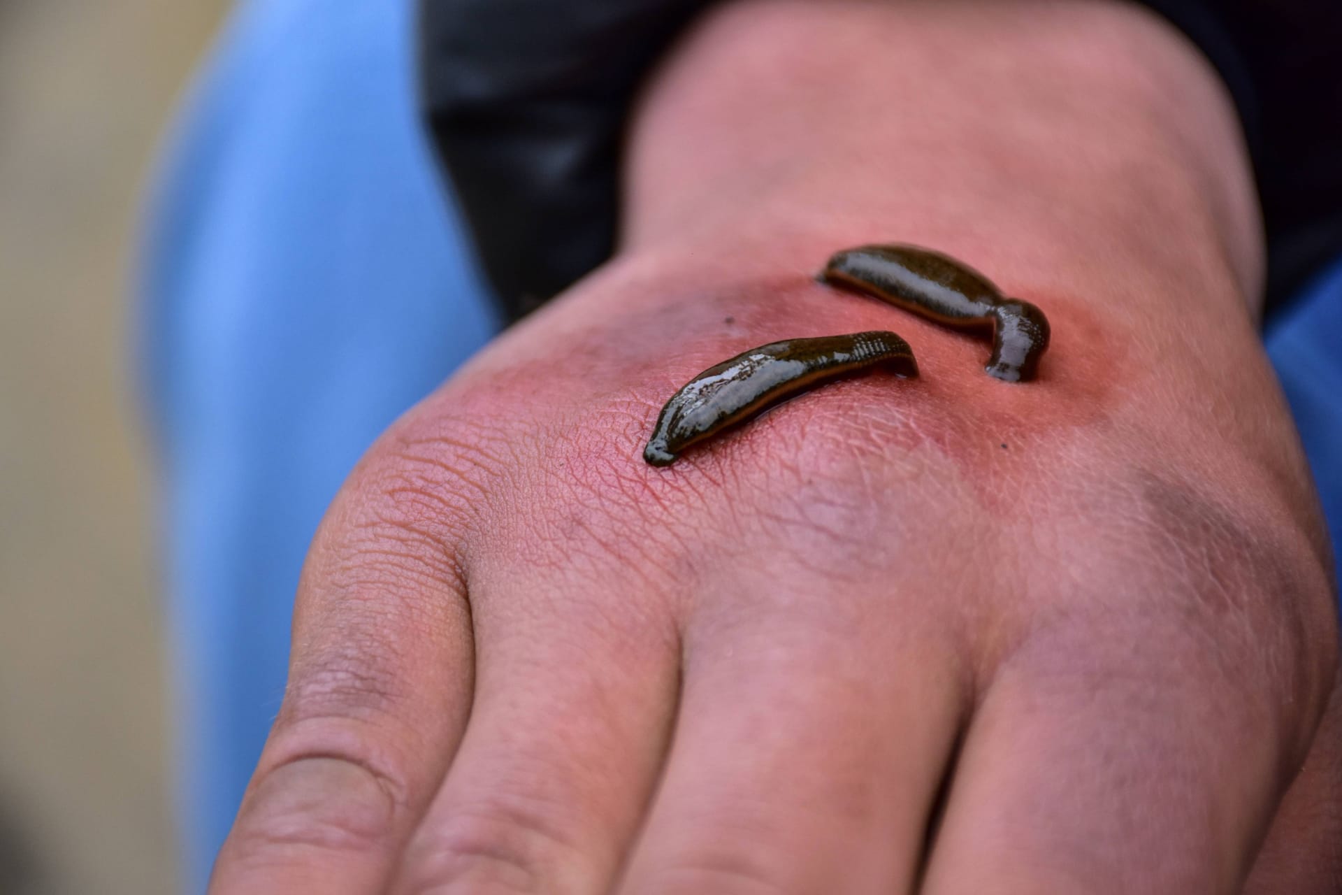 Blutegel auf einer Hand (Symbolbild): Die Wurmerkrankung betraf einen Bremer Patienten.