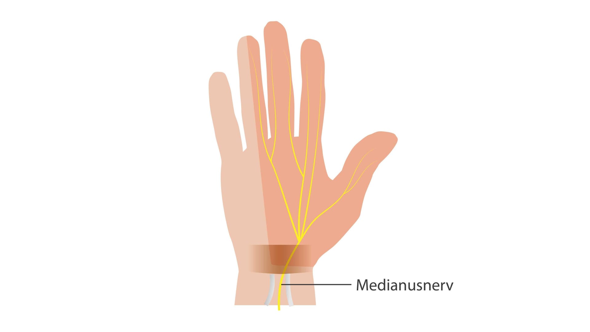 Karpaltunnelsyndrom: Im Handgelenk verläuft der Medianusnerv im Karpaltunnel.