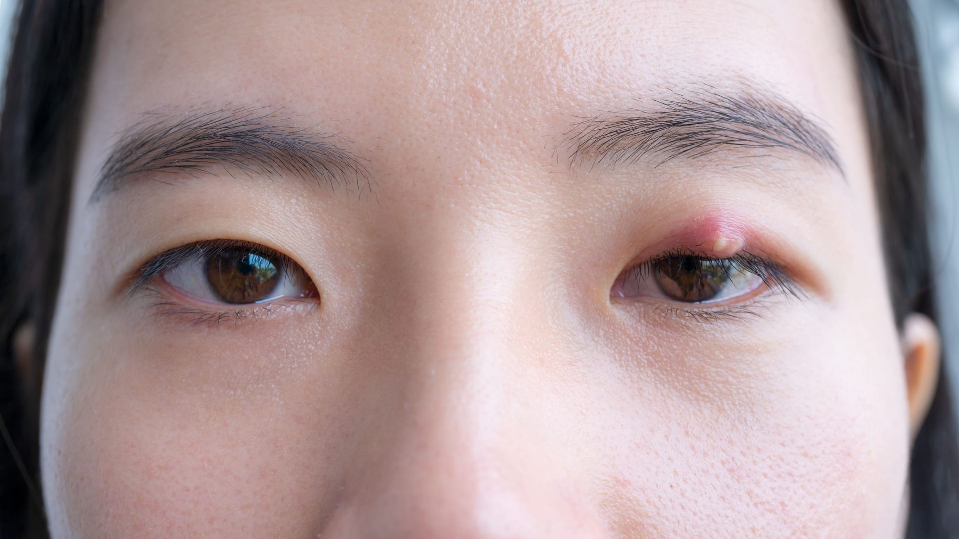 Gerstenkorn am äußeren Auge: Es erinnert optisch an einen Pickel.