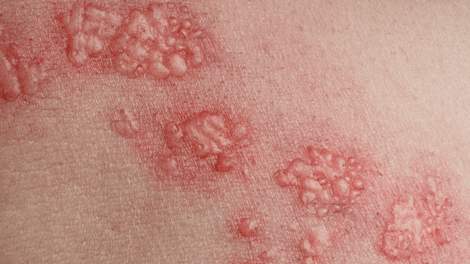 Der vermeintlich harmlose Hautausschlag bei einer Gürtelrose-Erkrankung ist oft nur das sichtbare Symptom.