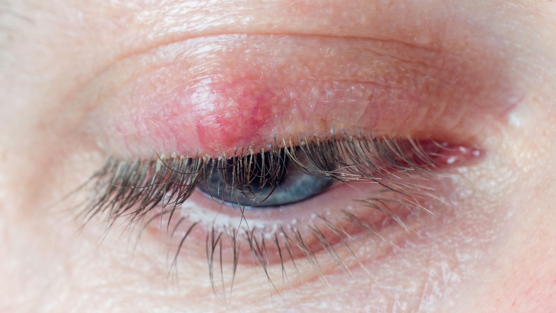 Hagelkorn am Auge: Optisch ähnelt es dem Gerstenkorn.