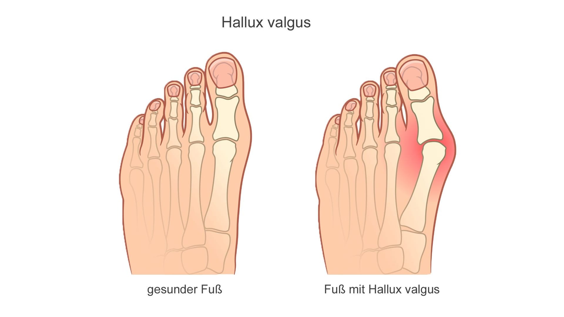 Hallux valgus ist auch als Ballenzeh bekannt.
