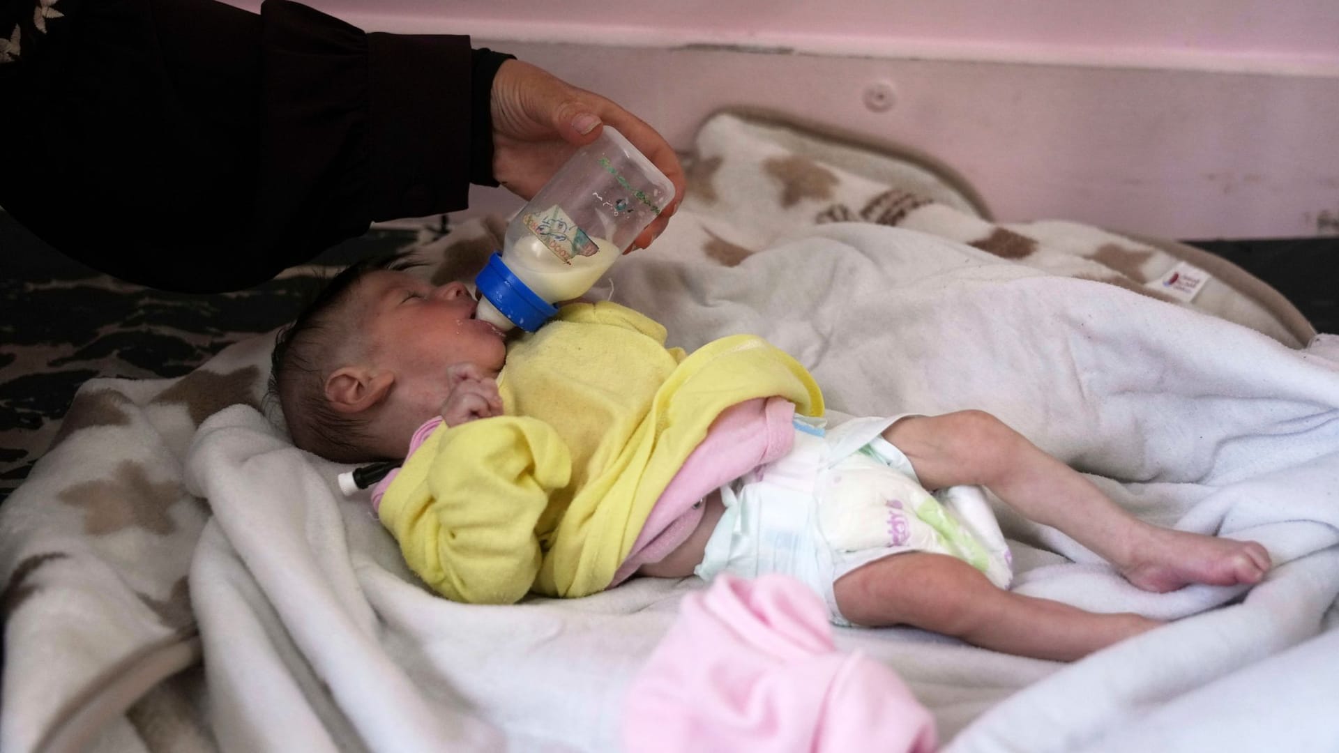 Mideast Wars Gaza Malnutrition