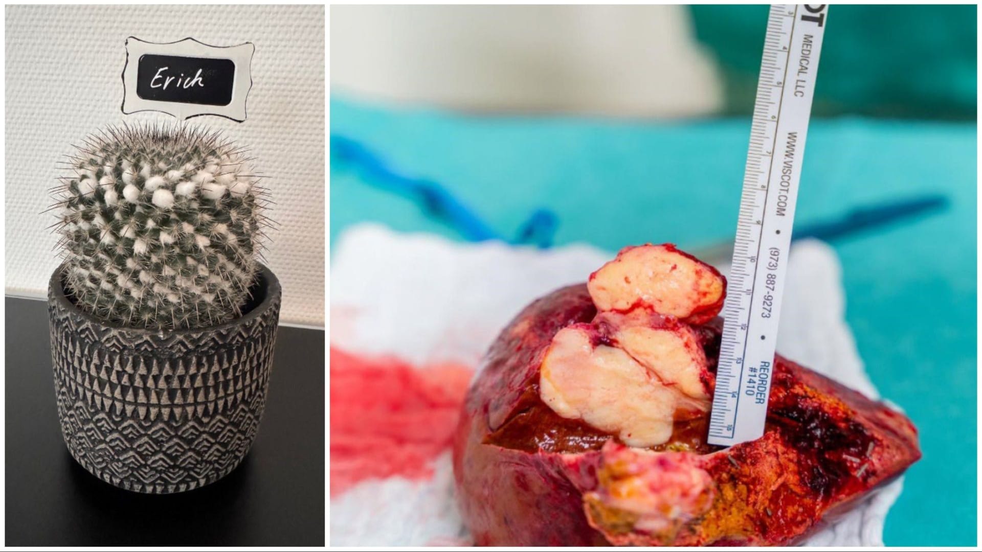 Kaktus "Erich" und der entfernte Leberlappen mit dem Tumor: Sie sind Symbol und Realität eines medizinischen Erfolgs.